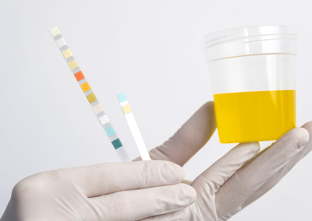 Finding the Right Urine Specimen Match