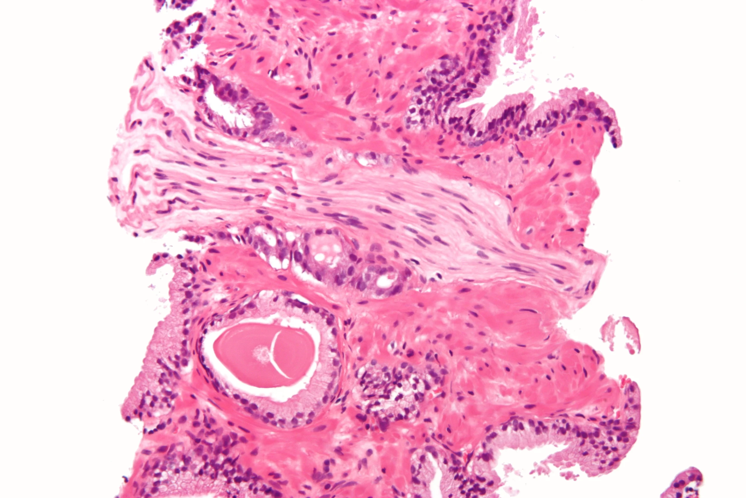 Bladder Cancer FFPE Blocks