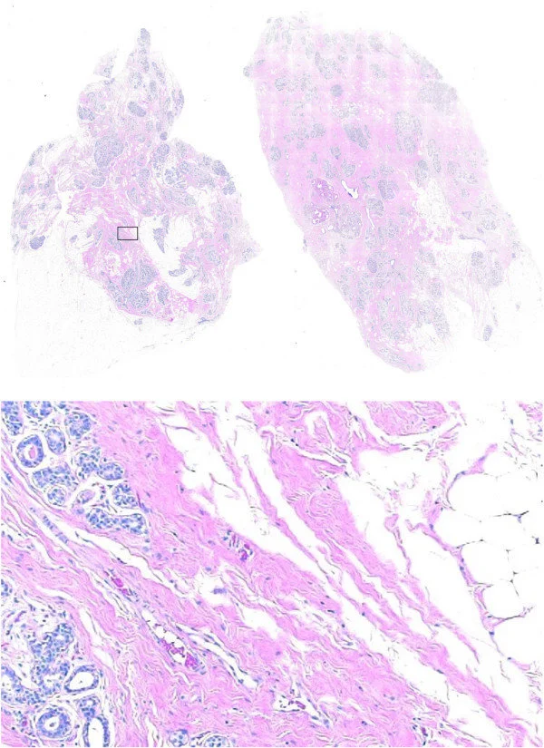 Breast Cancer Tissue Blocks