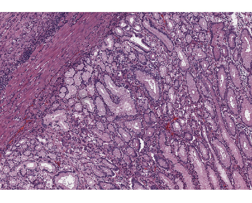 Gastric Cancer FFPE Blocks