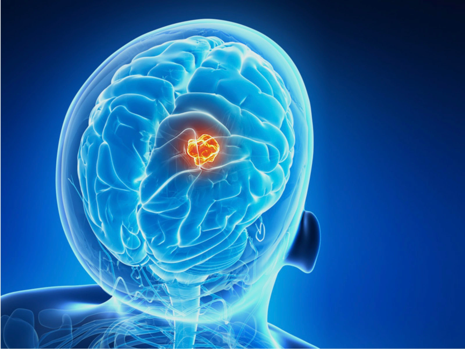 Glioblastoma Cancer FFPE Blocks