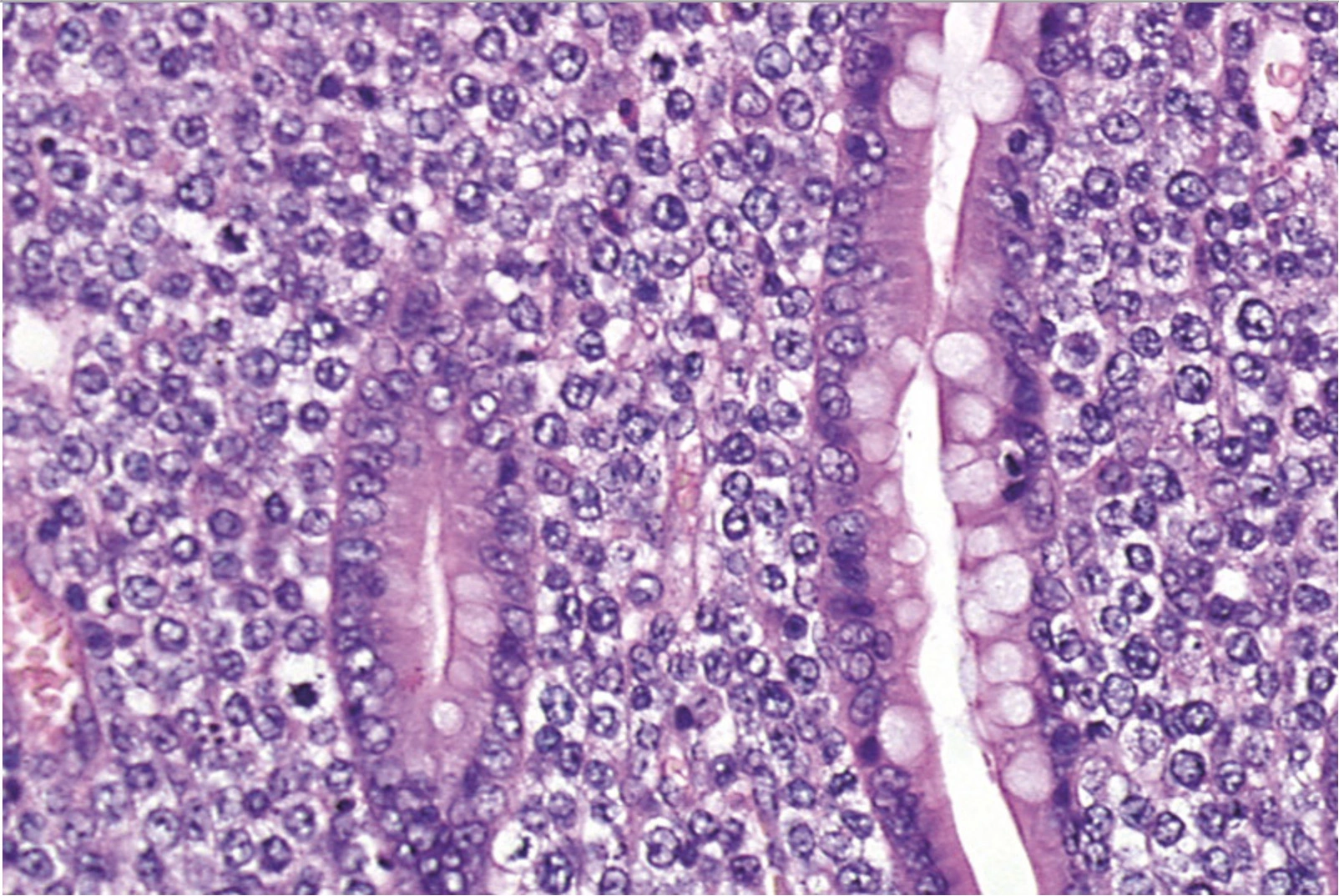 Leukemia Cancer FFPE Blocks