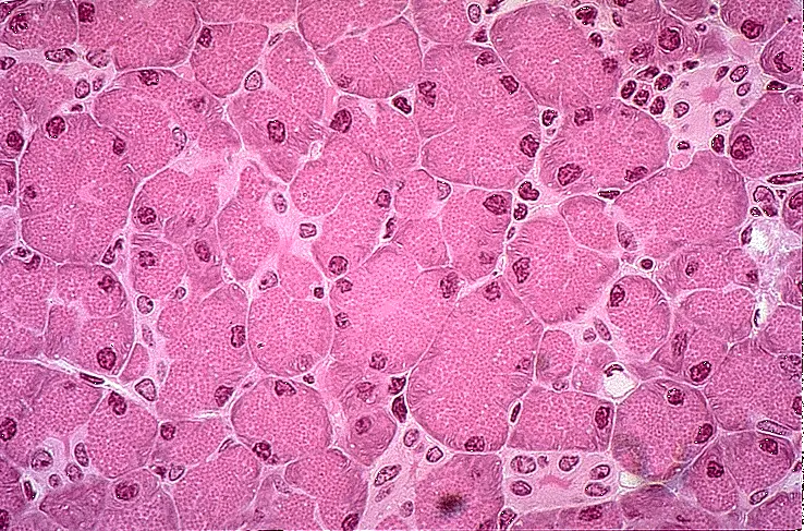 Pancreas Cancer FFPE Blocks