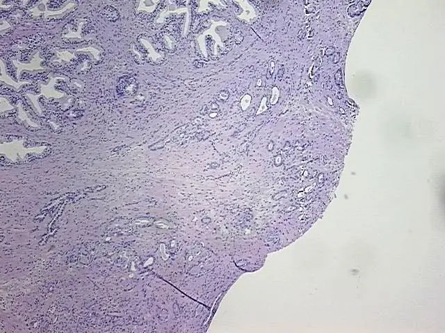 Prostate Cancer FFPE Blocks in USA