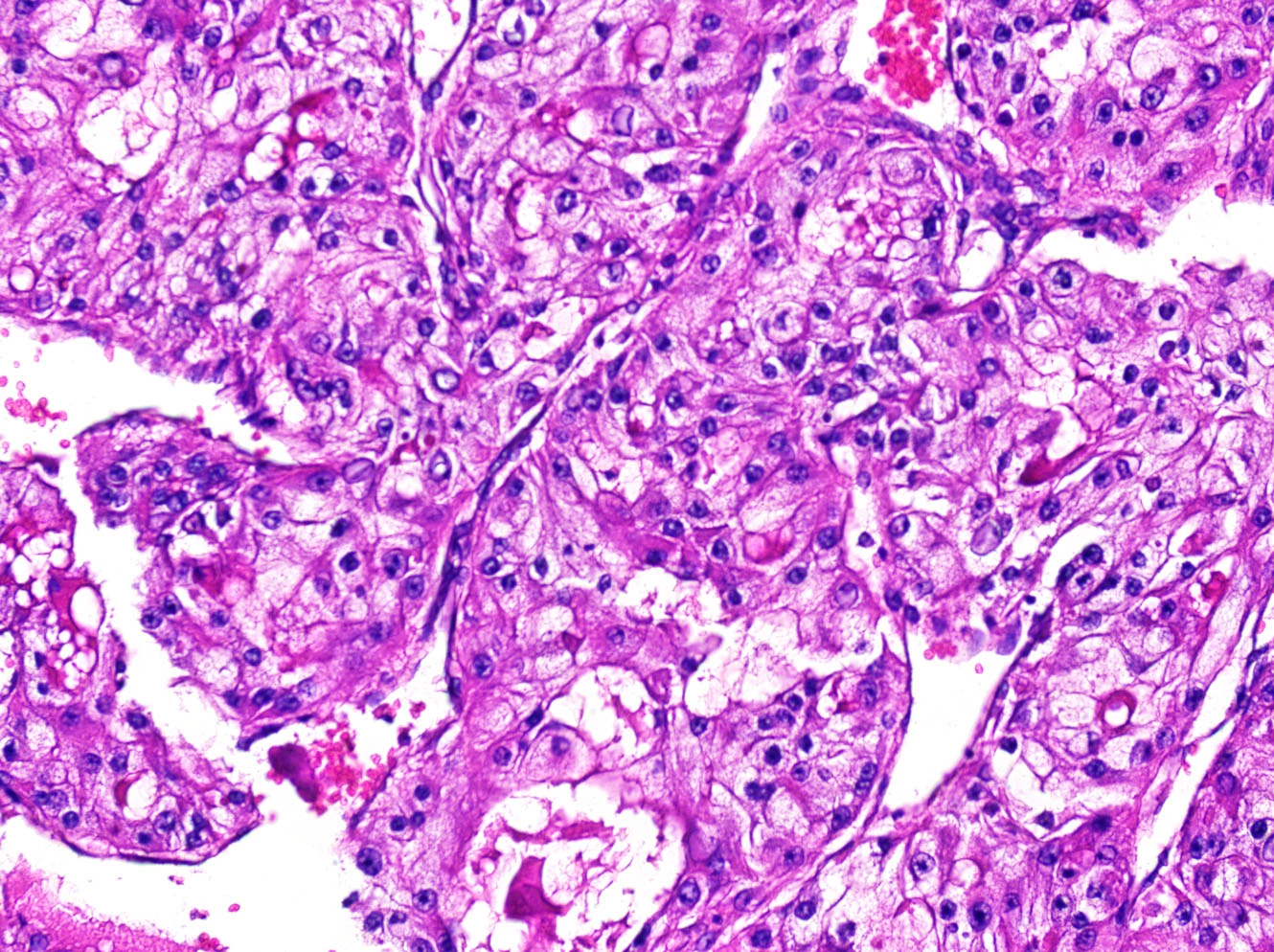 Renal Cell Carcinoma Cancer FFPE Blocks