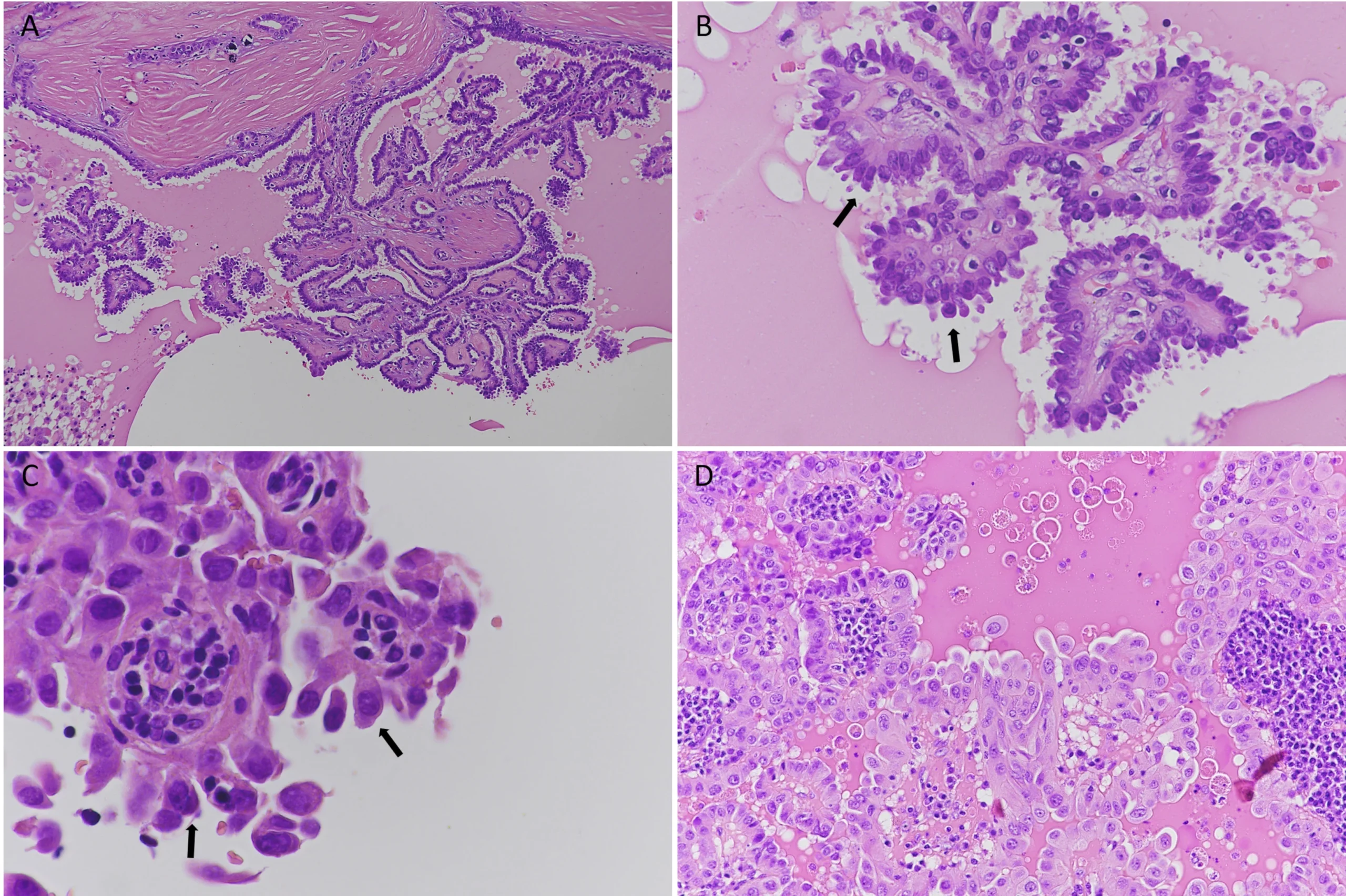 Thyroid Cancer FFPE Blocks